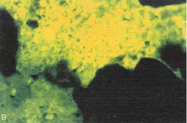 Photo. Thin section of interior portion of H C C: Same area as figure 159, but viewed with ultraviolet light causing fluorescence of the pore structure within the carbonated area.