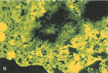 In this photo, the incident ultraviolet illumination causes fluorescence of the dye in the pore structure of the sand grain and indicates a zone of water accumulation (a cause of weakness). This cannot be seen in the plane polarized light view in figure 170.