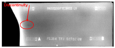 The radiographic image shows one longitudinal discontinuity that is located left of marker A and circled for illustrative purposes.